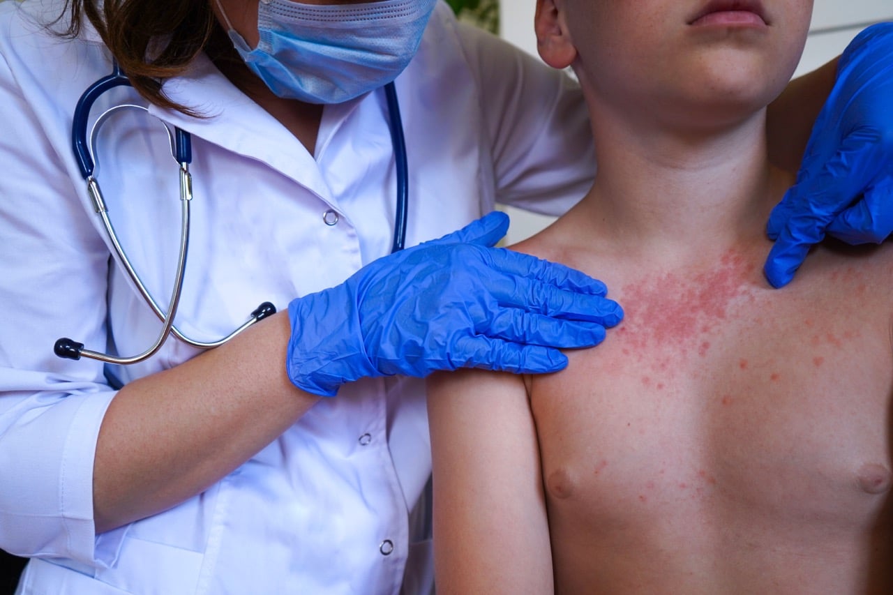 Child Rashes During the Summer | All Kidz Urgent Care