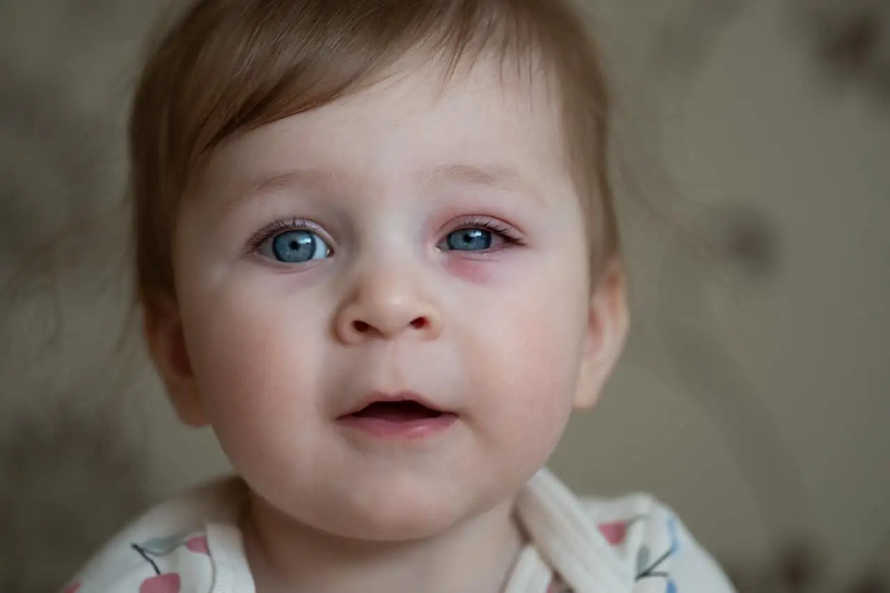 How to Tell if Your Child Has Pink Eye or Just Allergies | All Kidz Urgent Care