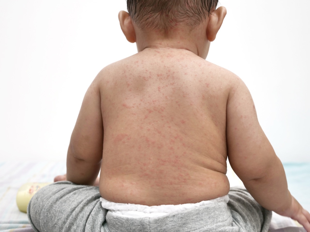 Recognizing Measles Symptoms in Children Early | All Kidz Urgent Care