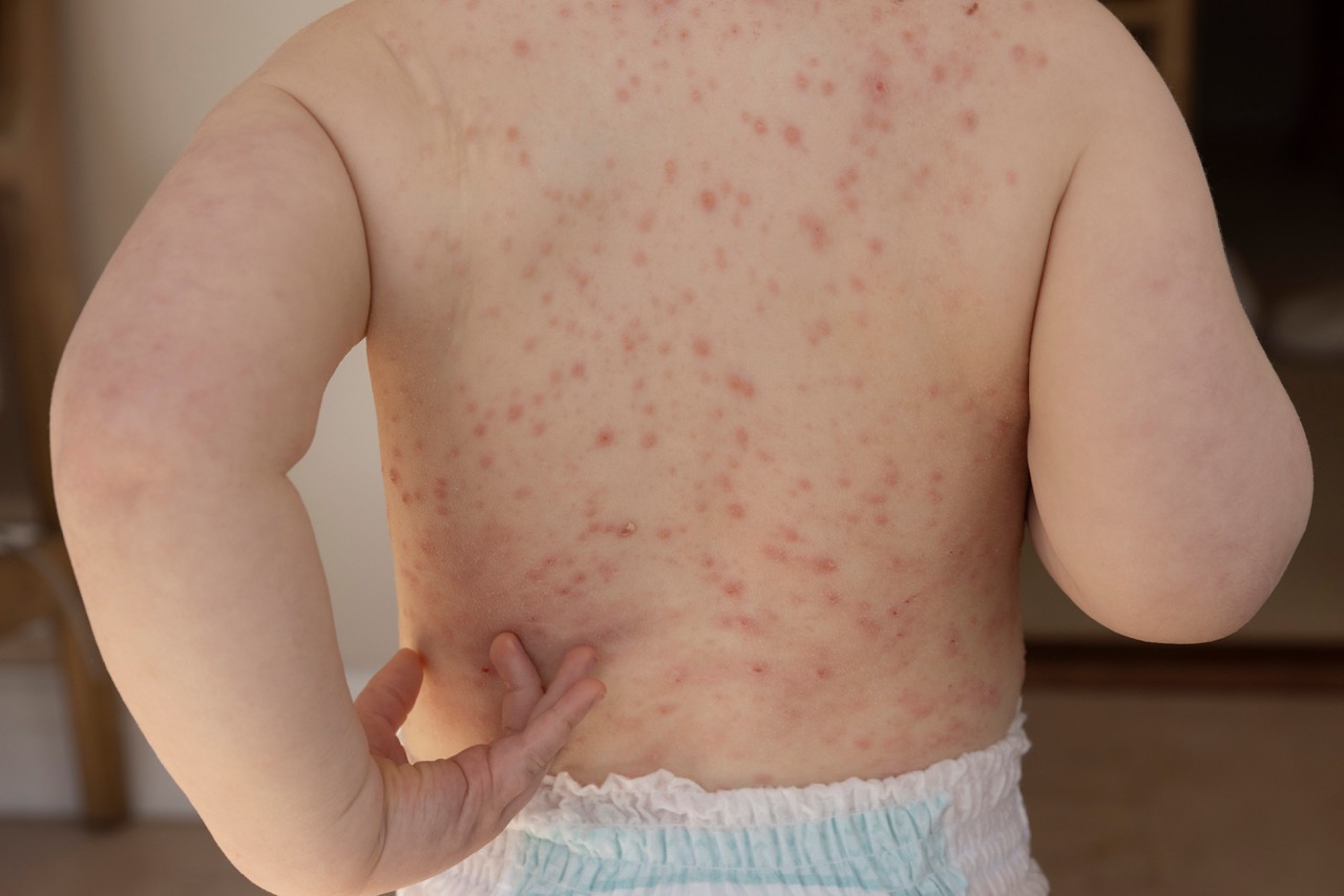 Measles Symptoms in Children: What Every Parent Needs to Know