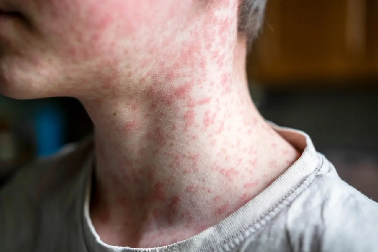 California Measles Vaccine Requirements for Children
