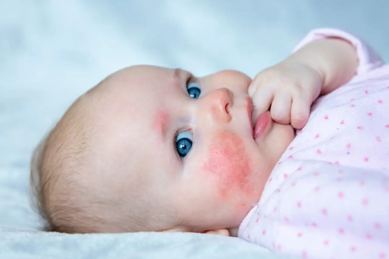 Baby Face Rashes: What Is Normal and When to Call a Pediatrician